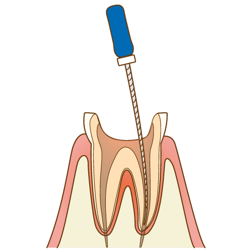 セラミック治療での歯並び改善は2次むし歯や歯根破折のリスクが高まります