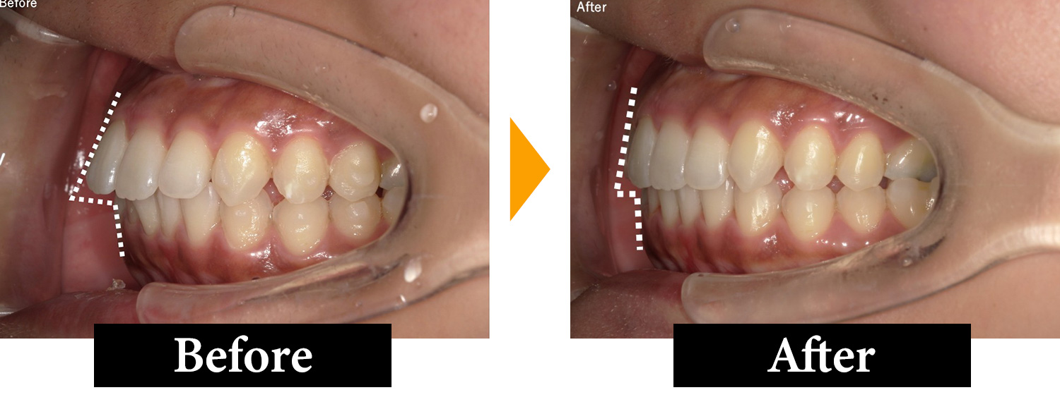 マウスピース矯正の実績