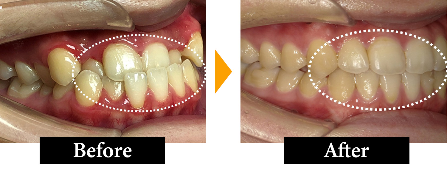 マウスピース矯正の実績